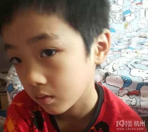 费曼受伤,费曼疤痕还是那么明显(费曼受什么伤) 费曼受伤,费曼疤痕还是那么明显(费曼受什么伤)