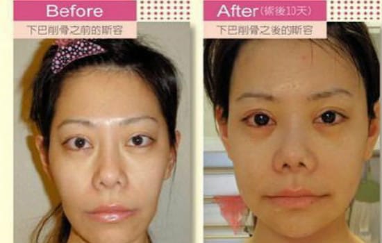 整容后遗症有多可怕?整容老了以后真可怕图 本文共(632字) 整容后遗症有多可怕?整容老了以后真可怕图 本文共(632字)