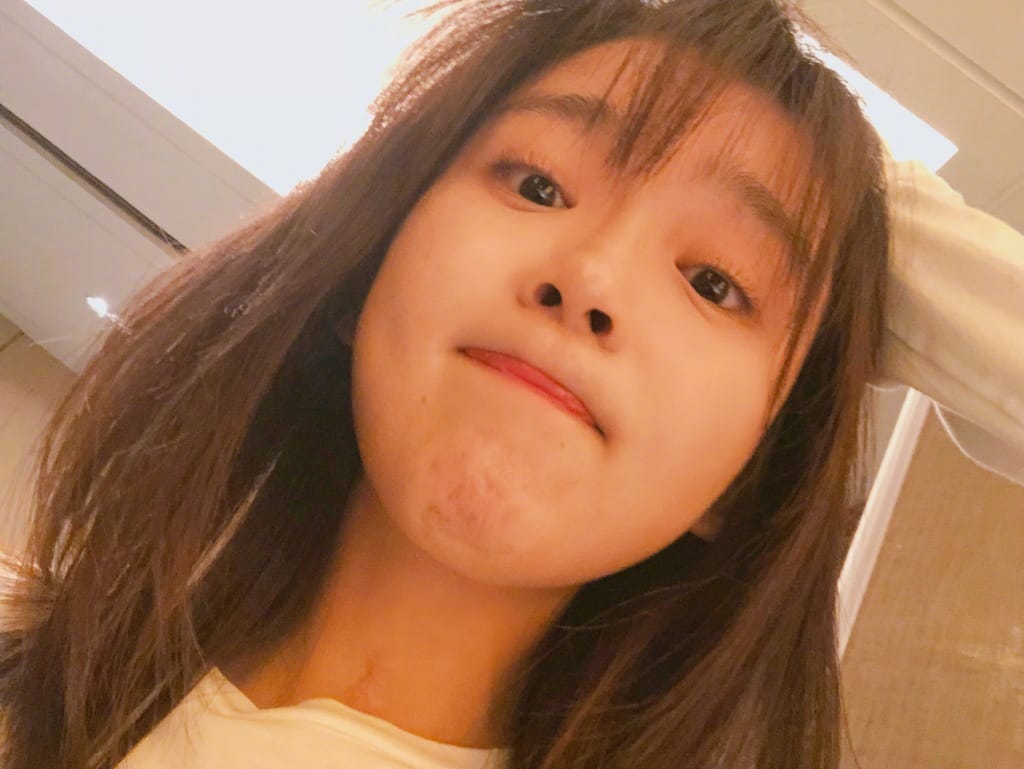 宋伊人如何考上北大的?宋伊人脖子上的伤疤 宋伊人如何考上北大的?宋伊人脖子上的伤疤