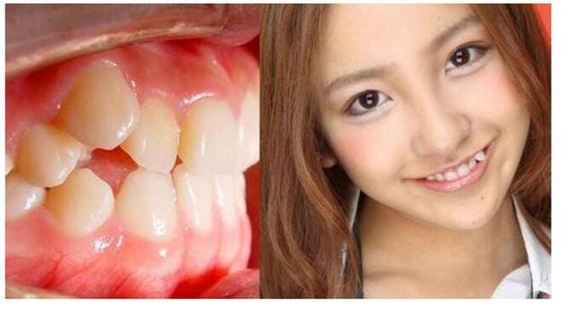 有虎牙的人好不好?虎牙为什么不能拔掉 本文共(911字) 有虎牙的人好不好?虎牙为什么不能拔掉 本文共(911字)