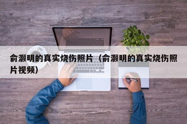 俞灏明的真实烧伤照片(俞灏明的真实烧伤照片视频) 俞灏明的真实烧伤照片(俞灏明的真实烧伤照片视频)