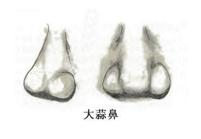 蒜头鼻是不是没有鼻梁?蒜头鼻子的女人面相好吗? 本文共(1005字) 蒜头鼻是不是没有鼻梁?蒜头鼻子的女人面相好吗? 本文共(1005字)