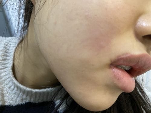 郑爽嘴角伤疤原因,郑爽嘴巴为什么(郑爽嘴唇上的疤) 郑爽嘴角伤疤原因,郑爽嘴巴为什么(郑爽嘴唇上的疤)