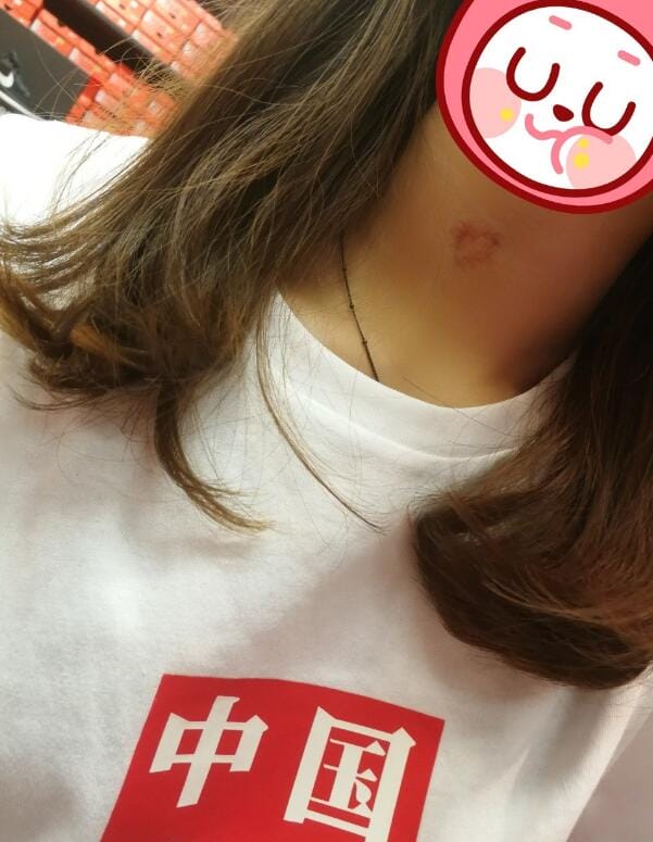 用什么借口来掩饰脖子上的草莓印,什么化妆品能遮草莓印? 本文共(972字) 用什么借口来掩饰脖子上的草莓印,什么化妆品能遮草莓印? 本文共(972字)