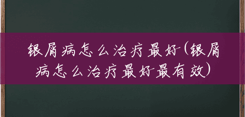 银屑病怎么治疗最好(银屑病怎么治疗最好最有效) 银屑病怎么治疗最好(银屑病怎么治疗最好最有效)