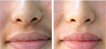 唇部激光脱毛需要多少次才能达到完美效果？