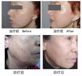 不再为痘印发愁!激光去除痘印价格公开透明! 不再为痘印发愁!激光去除痘印价格公开透明!