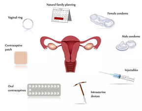 上环原理：阻断怀孕途径，让避孕更加可靠！