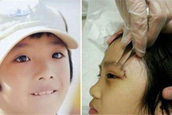 费曼怎么受伤的,费曼怎么伤到眼睛(费曼受什么伤)